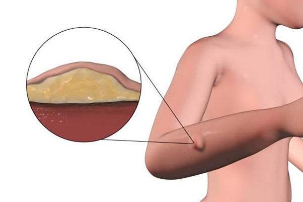 Types of Fatty Tumors Associated with Lipomas